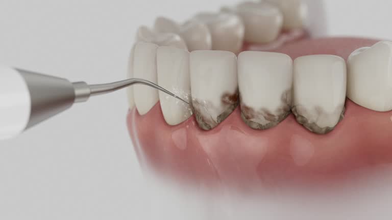 Trusted Wisdom Tooth Removal service in Cando, ND - Dentist Open Now